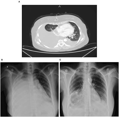 Case Report and Review of Literature: Familial Malignant Pleural Mesothelioma in a 39 Years Old Patient With an Inconclusive 18F-FDG PET/CT Result